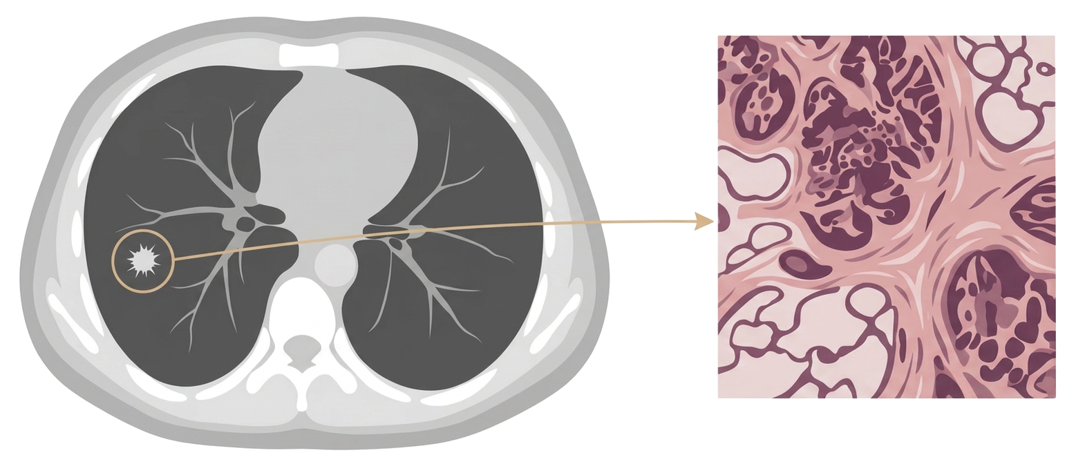 Graphic linking a stylized chest CT pulmonary nodule directly to a pathology specimen